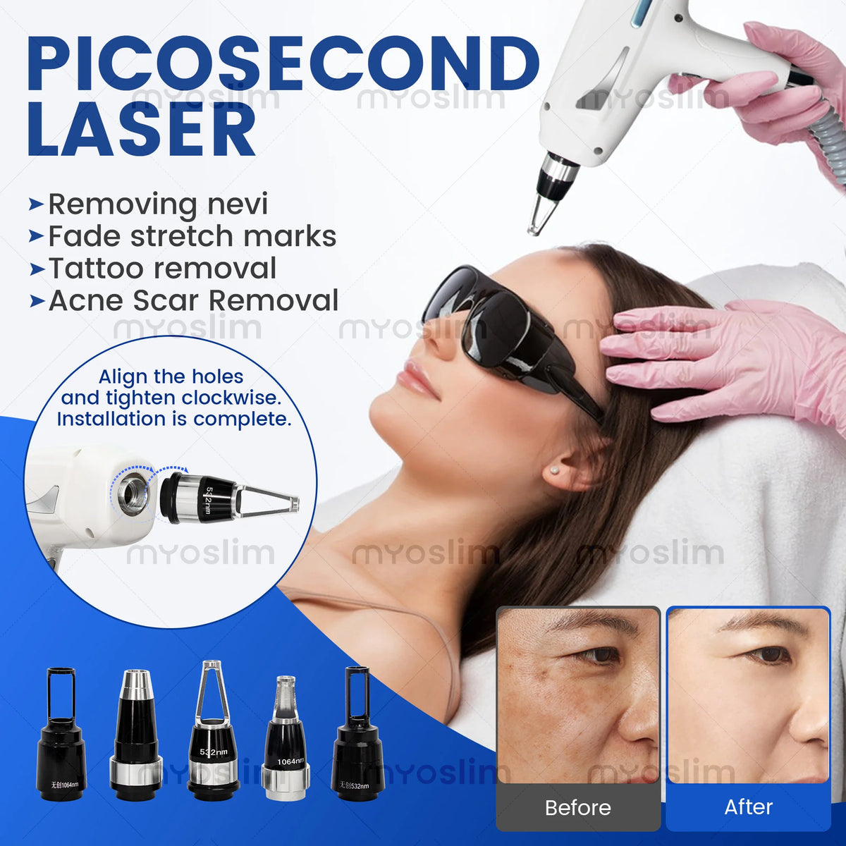 Myoslim 5000W Nd Yag Q Switch Laser Hair Removal Unit