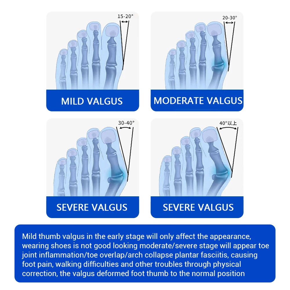 Moajaza Adjustable Bunion Aligner With Rotating Knob